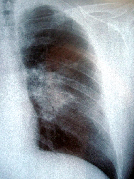 lungs1.jpg